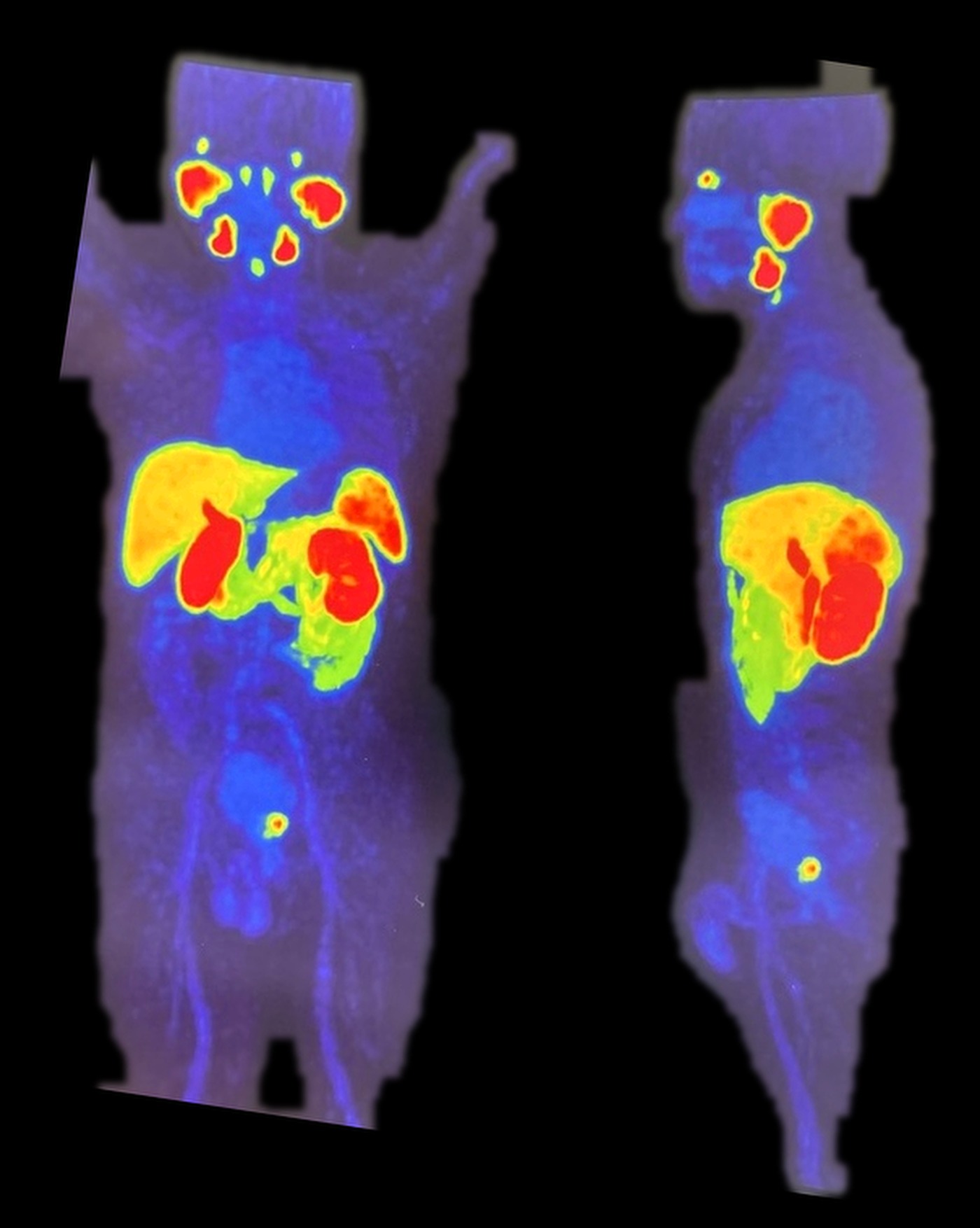PET-CT 18F-PSMA — estadificación